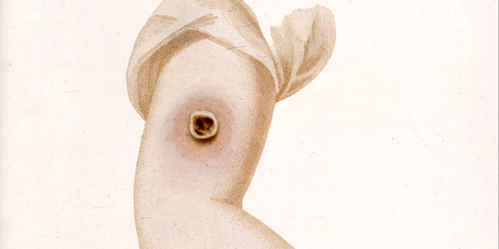 Le vaccin contre la variole